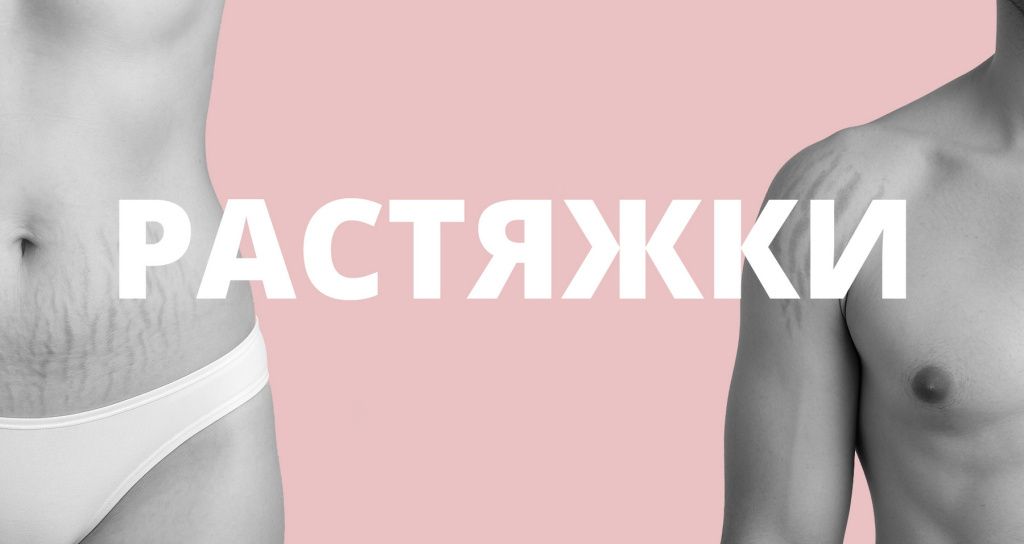 Как избавиться от растяжек