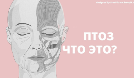 Птоз лица