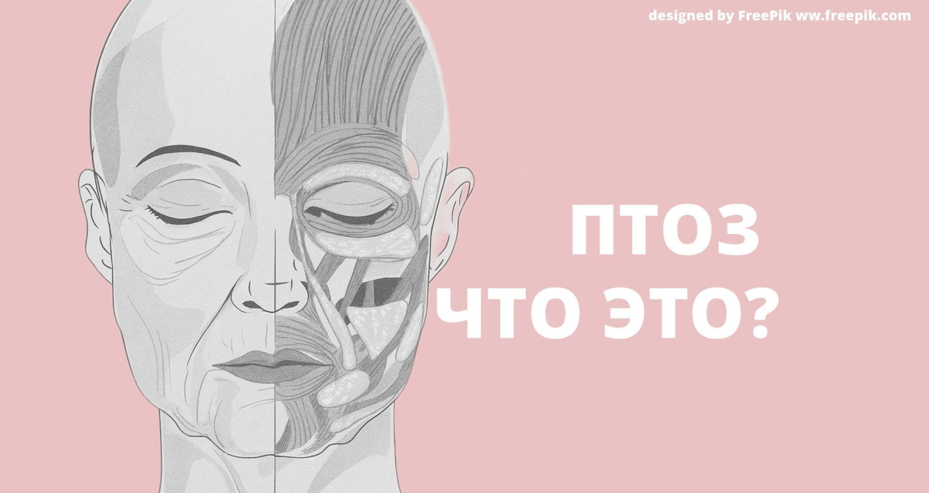 Птоз лица