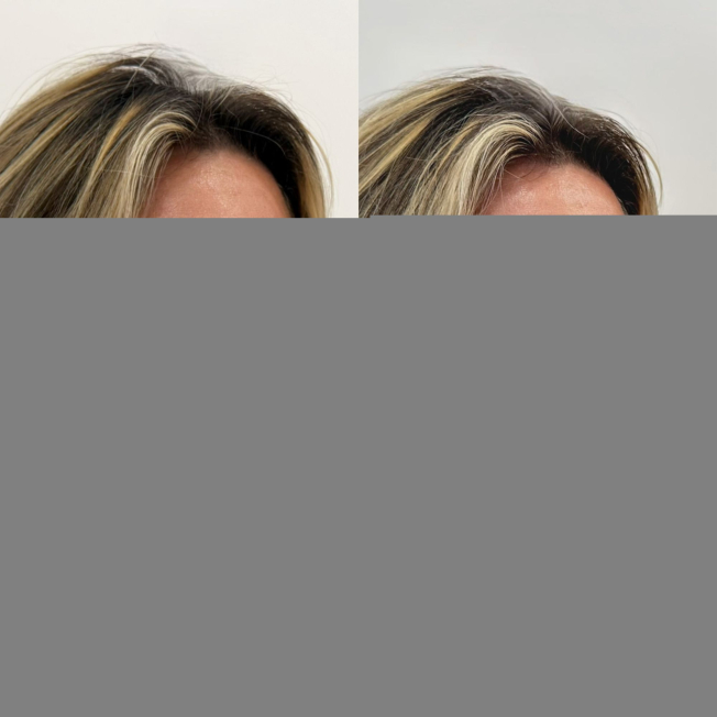 Деликатная FullFace-коррекция лица фото до и после 3